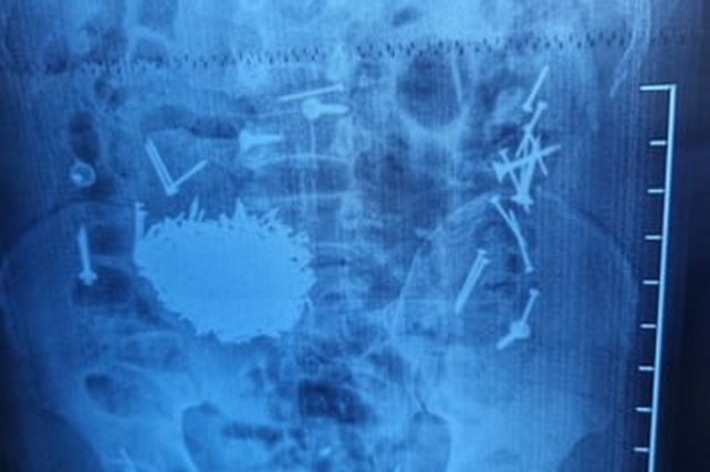 More Than 200 Grams of Nails and Screws Removed from Man’s Stomach in Samarkand